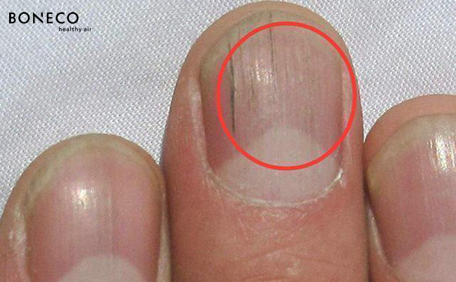 Ngón tay và móng tay nào thường xuyên bị bệnh gan?
